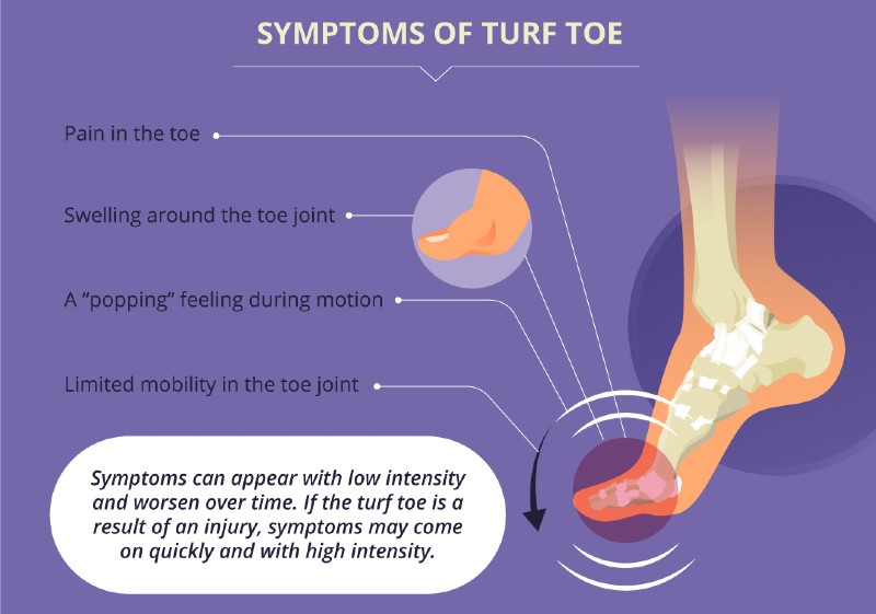 Turf Toe - Symptoms And Treatments